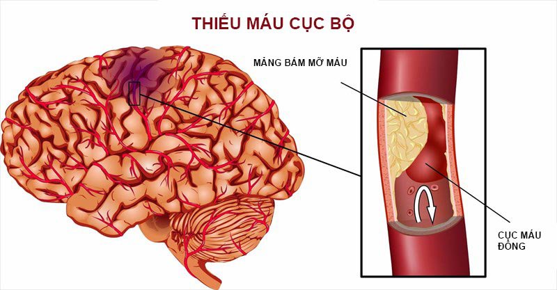80% đột quỵ xảy ra do cục máu đông