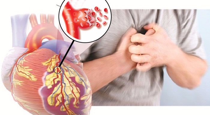 Đột quỵ não và đột quỵ tim khác nhau như thế nào?