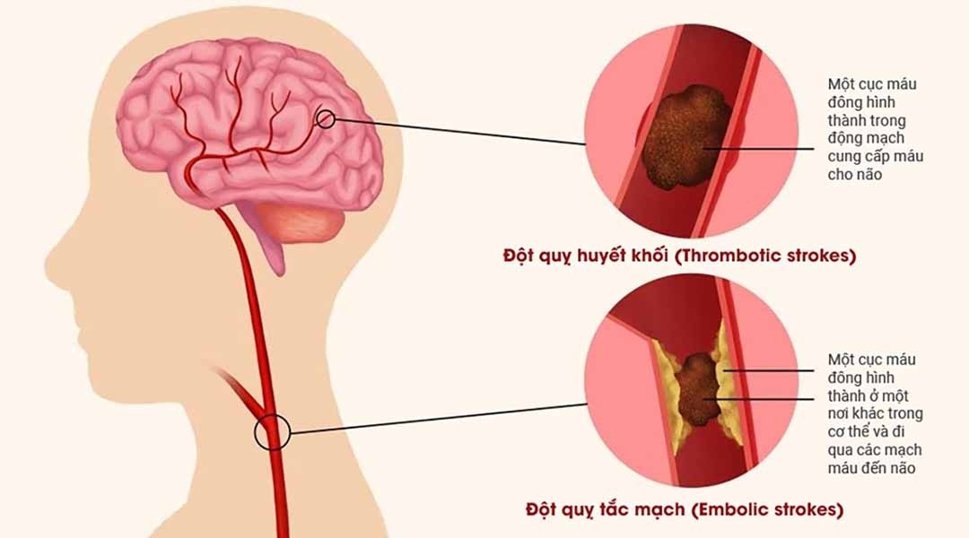 Đột quỵ do huyết khối, bạn cần biết gì?
