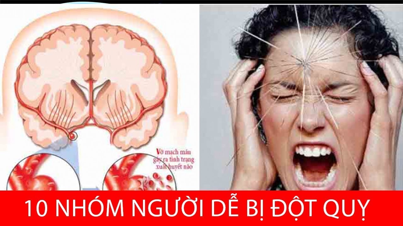 Lưu ý 10 nhóm người dễ bị đột quỵ nhất!