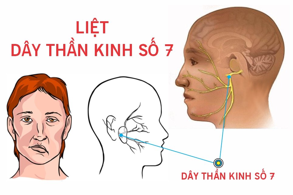 Liệt dây thần kinh số 7 có làm tăng nguy cơ đột quỵ?