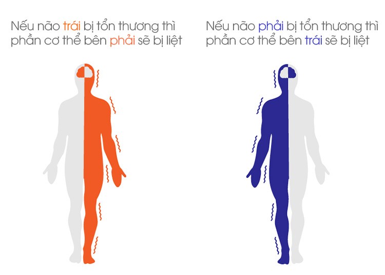 Đột quỵ bán cầu não phải sẽ ảnh hưởng đến khả năng vận động ở nửa trái cơ thể và ngược lại