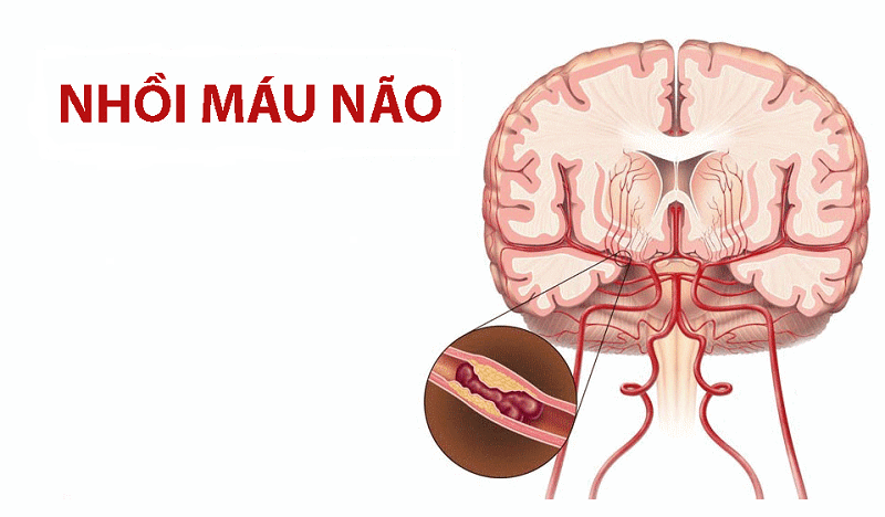 Nguyên nhân nào gây ra đột quỵ nhồi máu não?