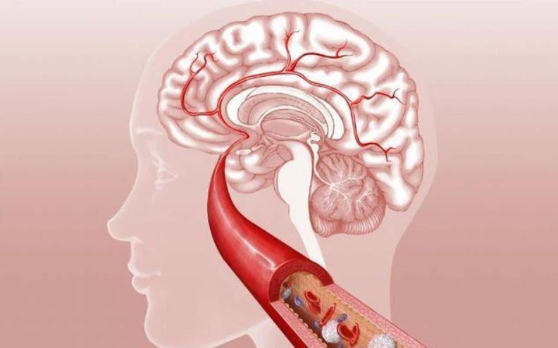 Đột quỵ có bao nhiêu loại?