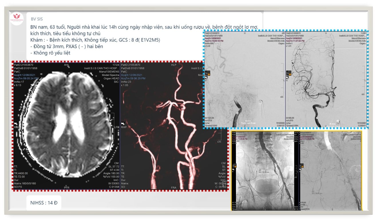 Hiếm gặp: Nam bệnh nhân đột quỵ nhồi máu não gần hết nửa não bên phải