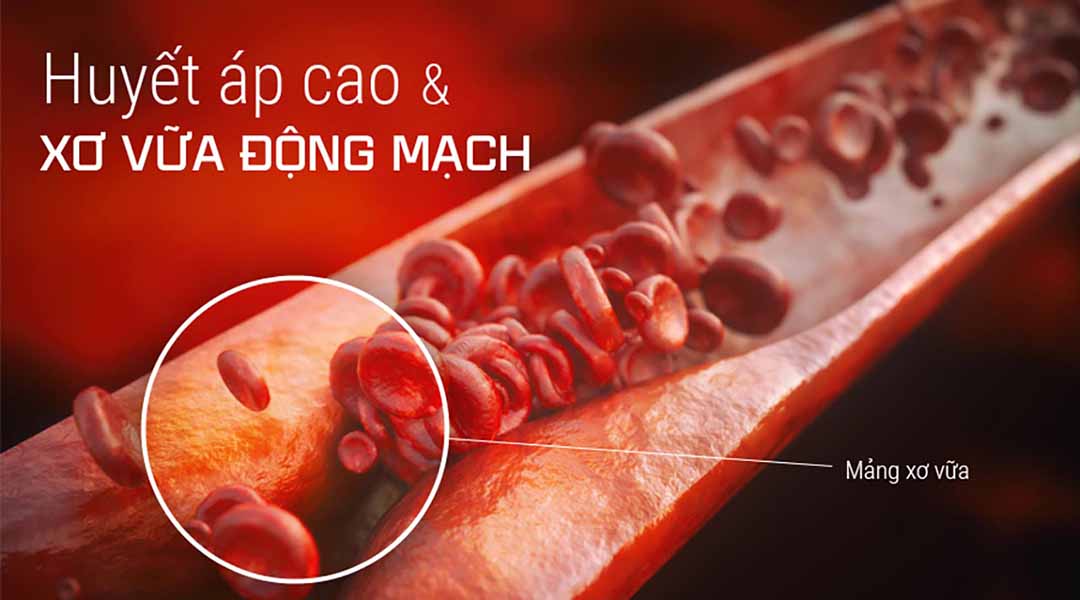 Vừa tăng huyết áp, vừa xơ vữa động mạch – nguy cơ đột quỵ nhân đôi