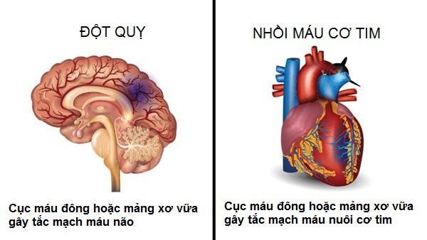 Sự khác nhau giữa nhồi máu cơ tim và đột quỵ?