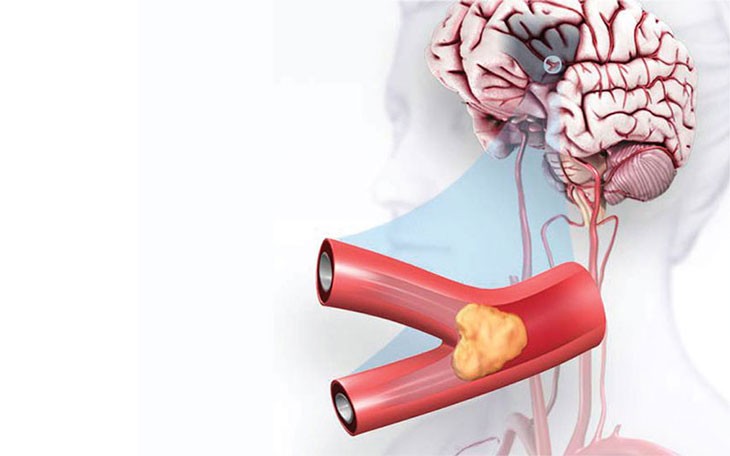 Tai biến mạch máu não có di truyền không?