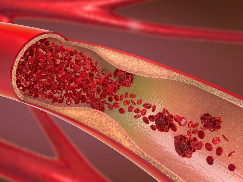 Tiếp xúc với kim loại độc hại ở mức độ thấp có thể làm tăng nguy cơ bị tắc nghẽn động mạch