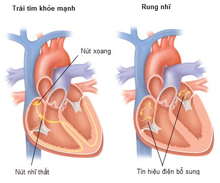 Rung nhĩ và đột quỵ, liệu có liên quan?