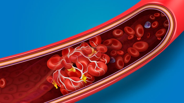 Cục máu đông hình thành là do kết quả của quá trình đông máu, nó sẽ theo hệ tuần hoàn máu đi lang thang khắp trong cơ thể.