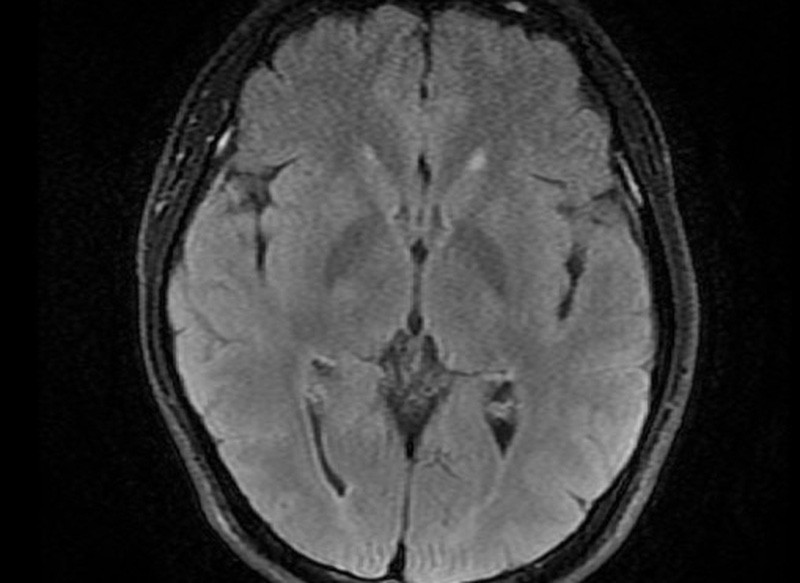 Quảng Ninh: Bệnh nhân trẻ tuổi bị đột quỵ não khi đang đi trên đường