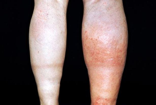 sưng tấy dấu hiệu máu đông