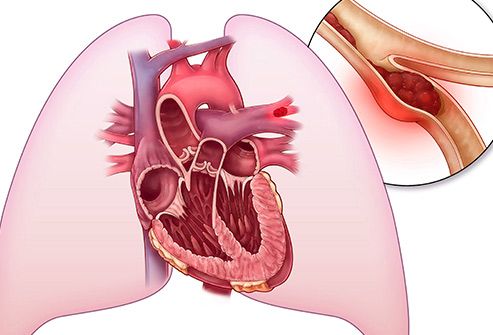 cục máu đông ở phổi