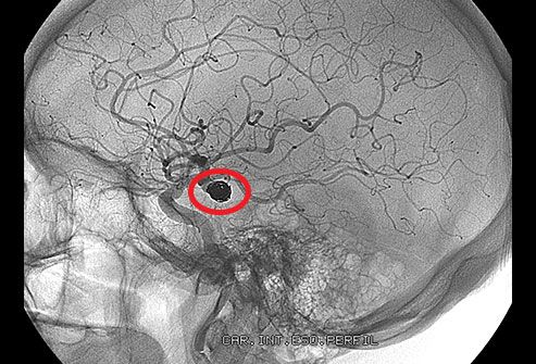cục máu đông ở não