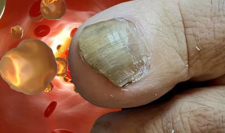 2 dấu hiệu cholesterol cao khi nhìn vào móng chân, giúp phòng tránh đột quỵ