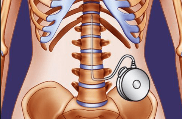 Liệu pháp Baclofen nội tủy cho chứng co cứng