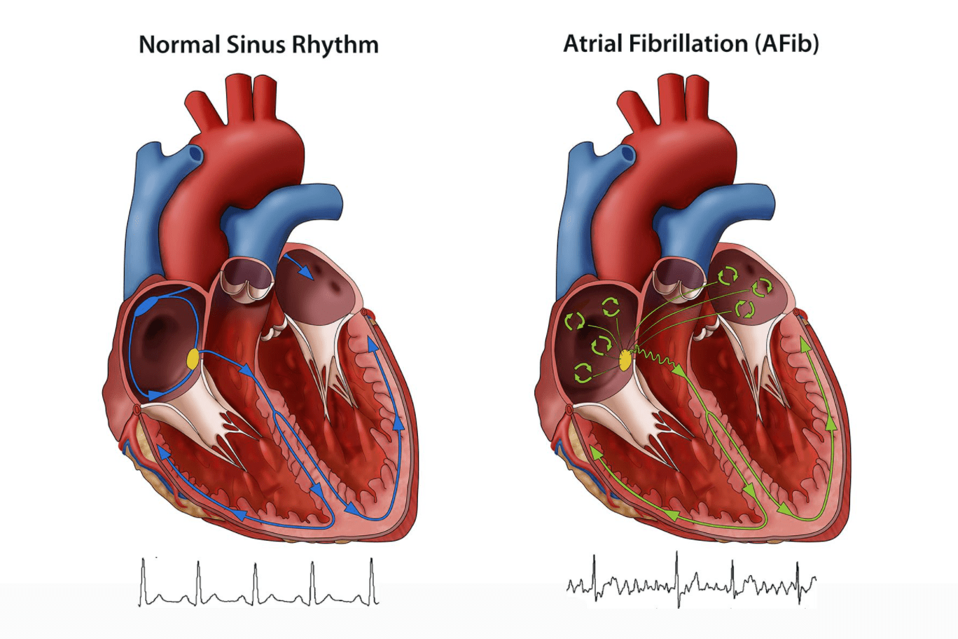 Liệu có cách phát hiện đột quỵ do rung nhĩ?