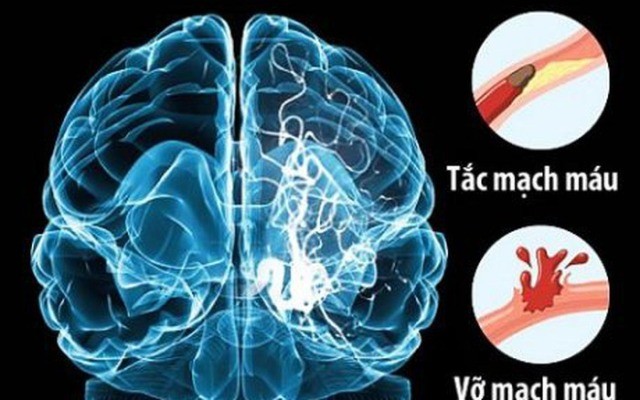 Vì sao đột quỵ thường xảy ra nhiều vào dịp tết