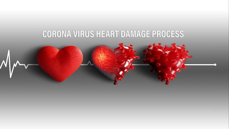 COVID-19: Ngay cả mức độ nhẹ cũng có thể gây ra bệnh tim hay đột quỵ một năm sau khi mắc