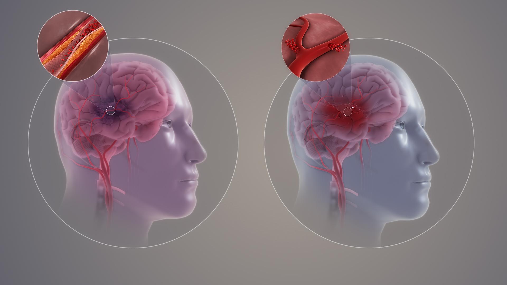 Đột quỵ liên quan đến các vấn đề tài chính ở các nước đang phát triển