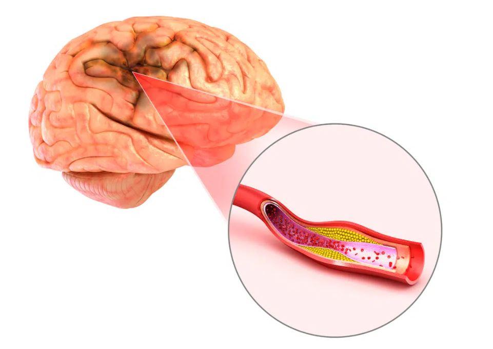 Cơn thiếu máu não thoáng qua thường kéo dài một vài phút. Hầu hết các dấu hiệu và triệu chứng biến mất trong vòng một giờ.