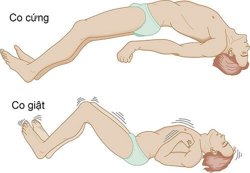 Những người sống sót sau đột quỵ có thể bị co giật