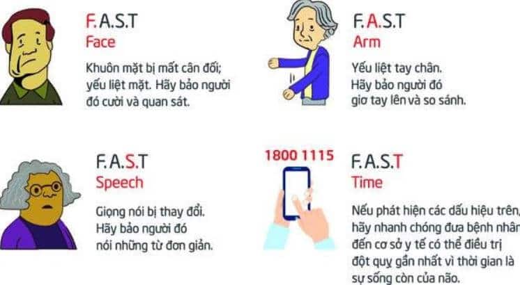 FAST giúp nhận biết đột quỵ dễ dàng