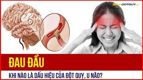 Đau đầu mức độ nào cảnh báo dấu hiệu của đột quỵ, u não?