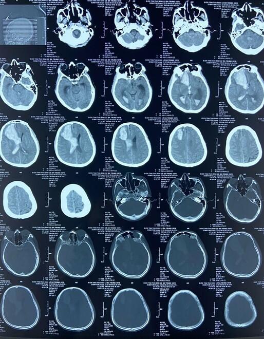 Người đàn ông đột quỵ chỉ vì nghiện rượu, tiên lượng tử vong cao