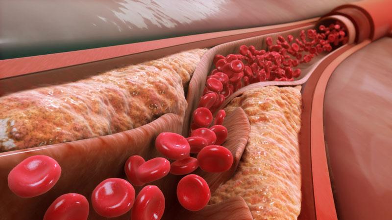 Giảm LDL Cholesterol chuyên sâu hơn có thể giảm nguy cơ đột quỵ tái phát