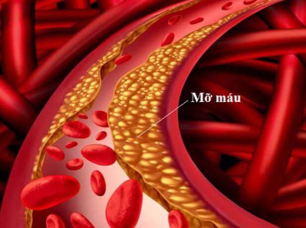 Bệnh mỡ máu: Phải “diệt tận gốc” từ nguyên nhân thì mới mong khỏi bệnh!