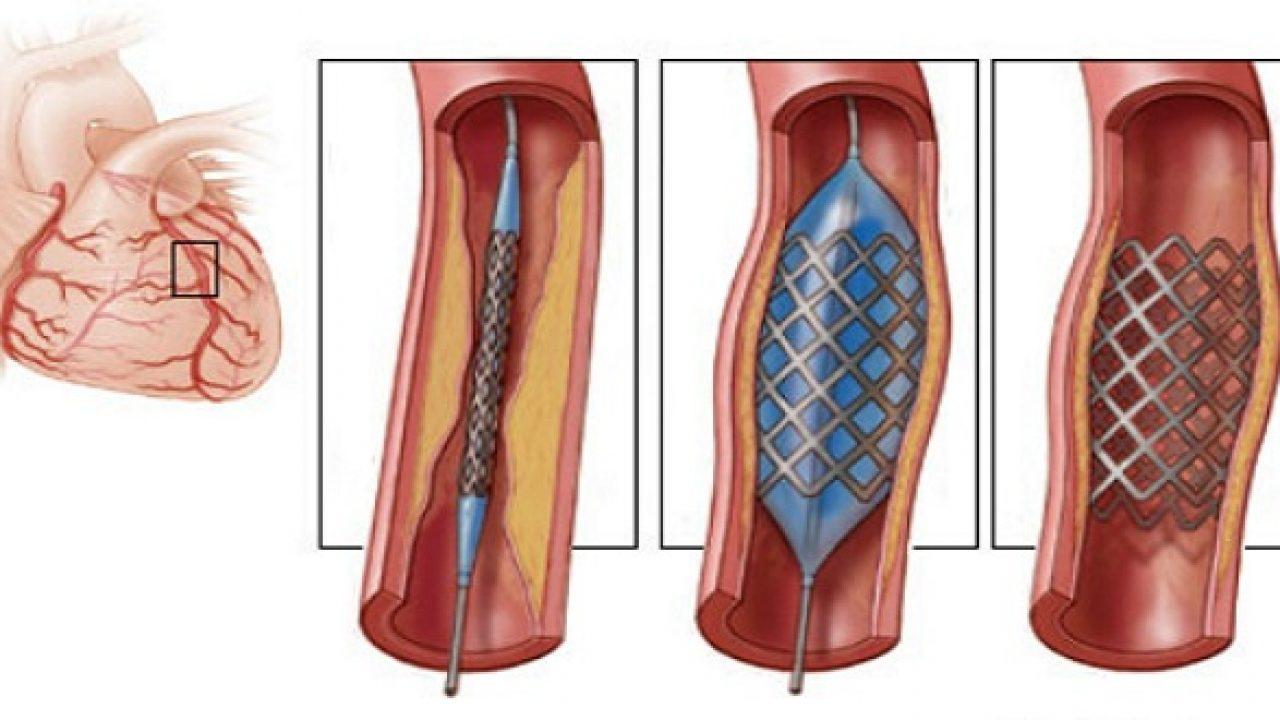 Nong động mạch cảnh thường được kết hợp với đặt cuộn dây kim loại nhỏ gọi là stent vào động mạch bị tắc.