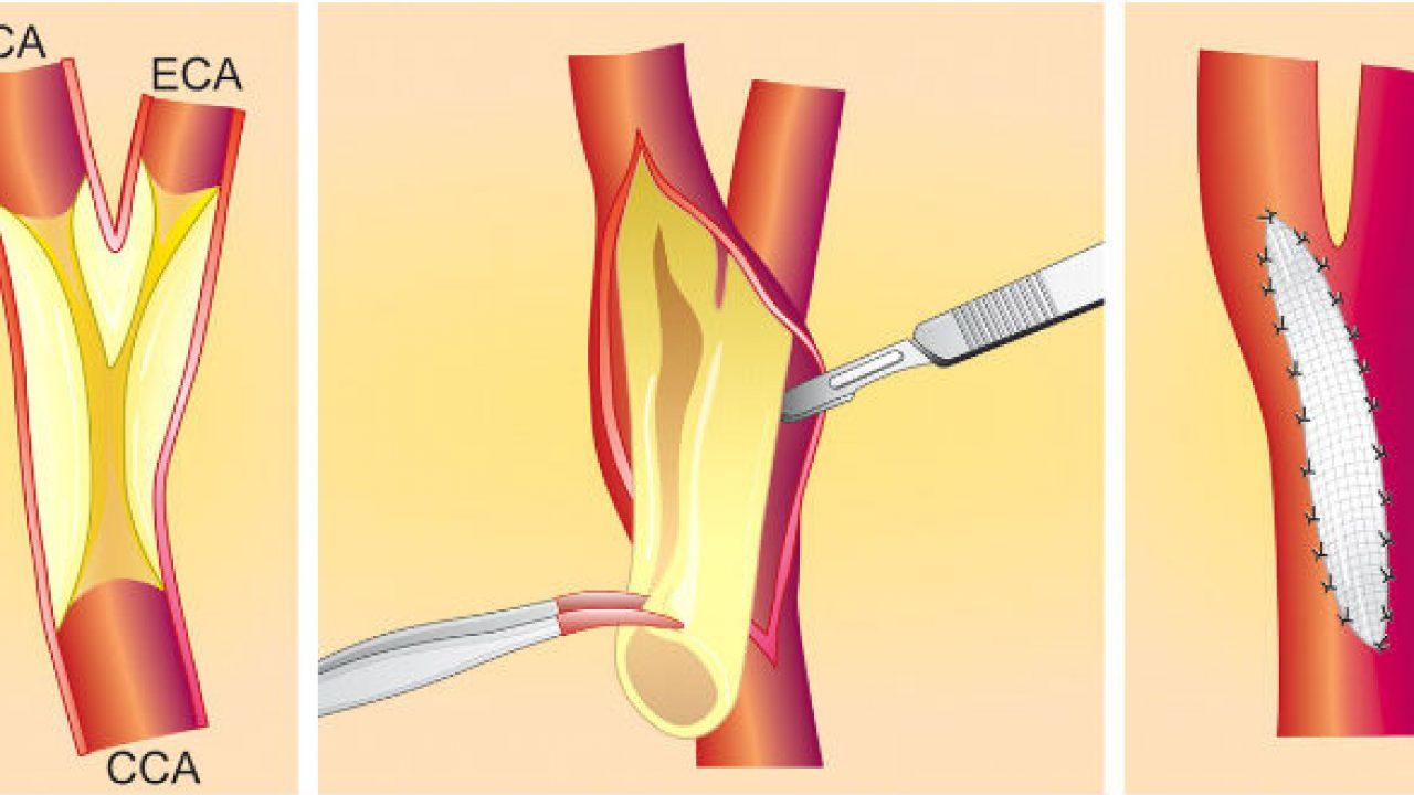 Cắt bỏ nội mạc động mạch cảnh giúp loại bỏ mảng xơ vữa khỏi động mạch và phục hồi dòng máu chảy qua.