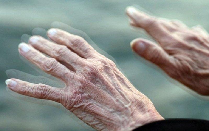 Bệnh Parkinson tiến triển có thể ảnh hưởng đến các tế bào thần kinh, làm thiếu hụt dopamine.