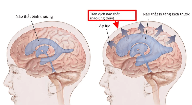 Những điều cần biết về viêm màng não do lao