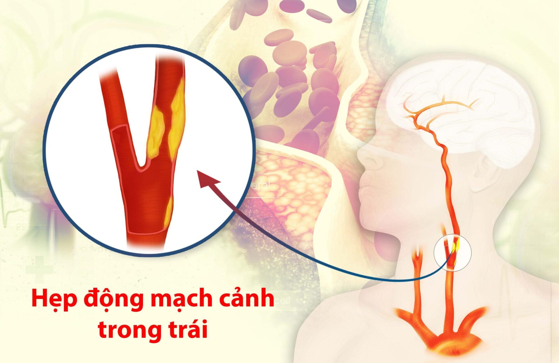 Bị hẹp động mạch cảnh, khám ở đâu?