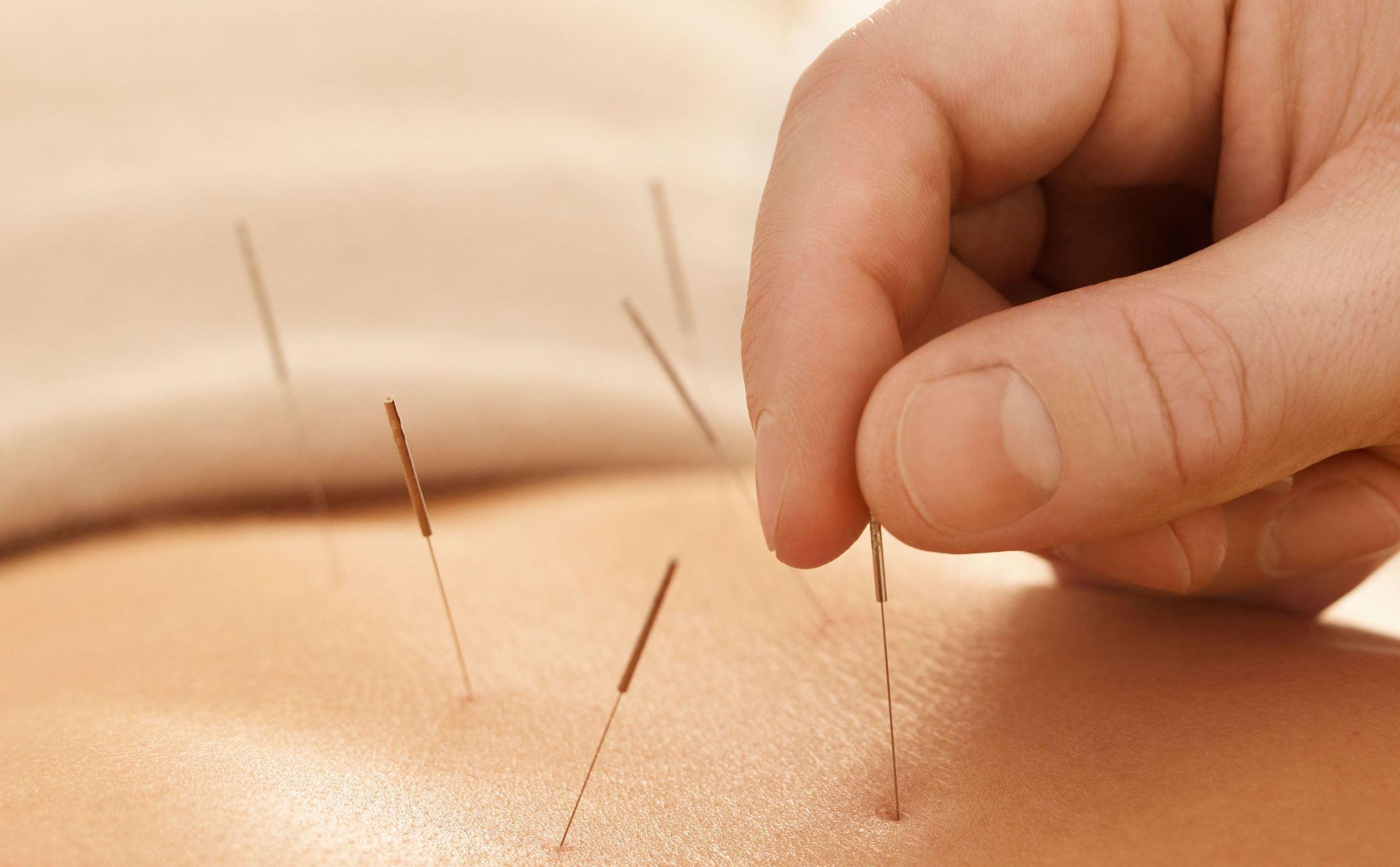 6 liệu pháp y học cổ truyền bổ sung và thay thế trong phục hồi đột quỵ