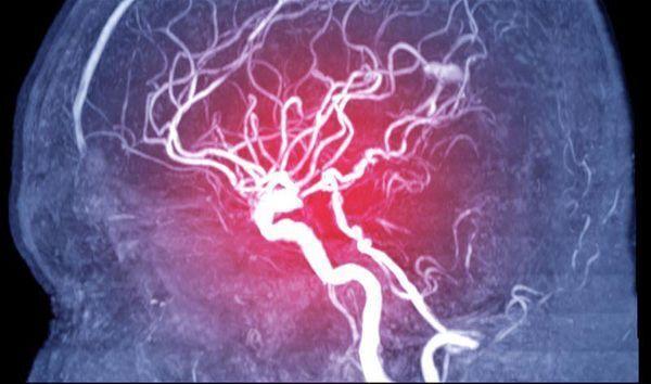 Thiệt hại dây thần kinh có thể giúp thúc đẩy một số trường hợp hậu COVID-19