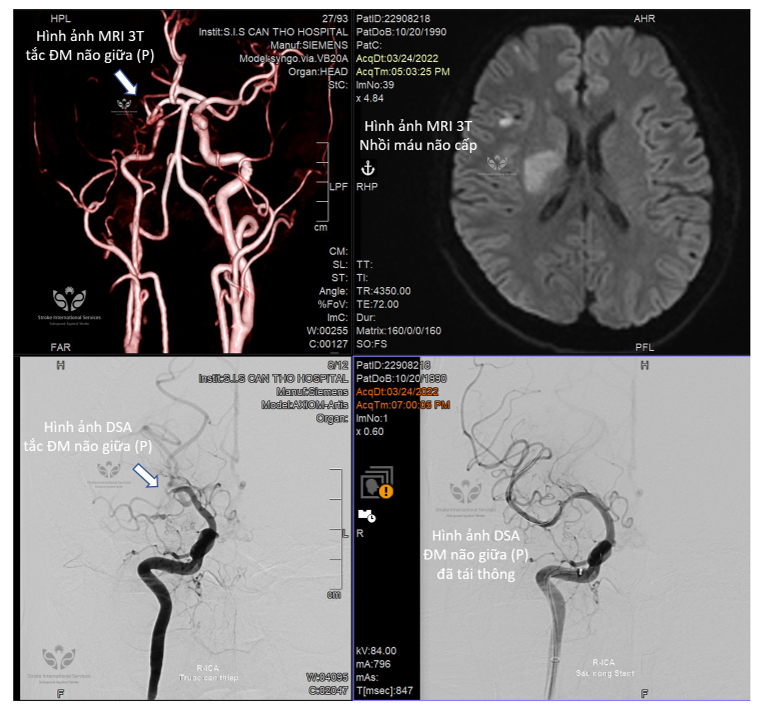 Chuyển viện kịp thời trong giờ vàng, bác sĩ trẻ bị đột quỵ hồi phục nhanh chóng