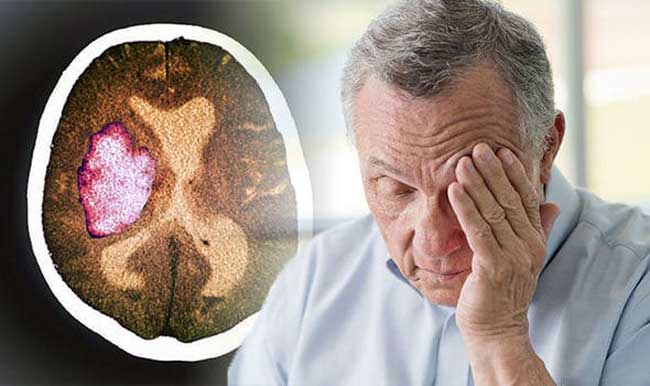 Một người có thể sống sót sau cơn đột quỵ xuất huyết não không?
