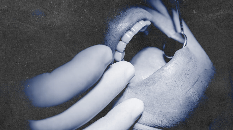 Mối quan hệ giữa vi khuẩn miệng và tăng huyết áp