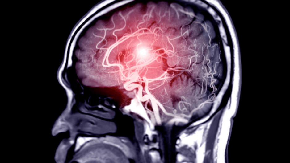 Các ca đột quỵ tăng ở người trẻ tuổi, phụ nữ bị ảnh hưởng nhiều hơn