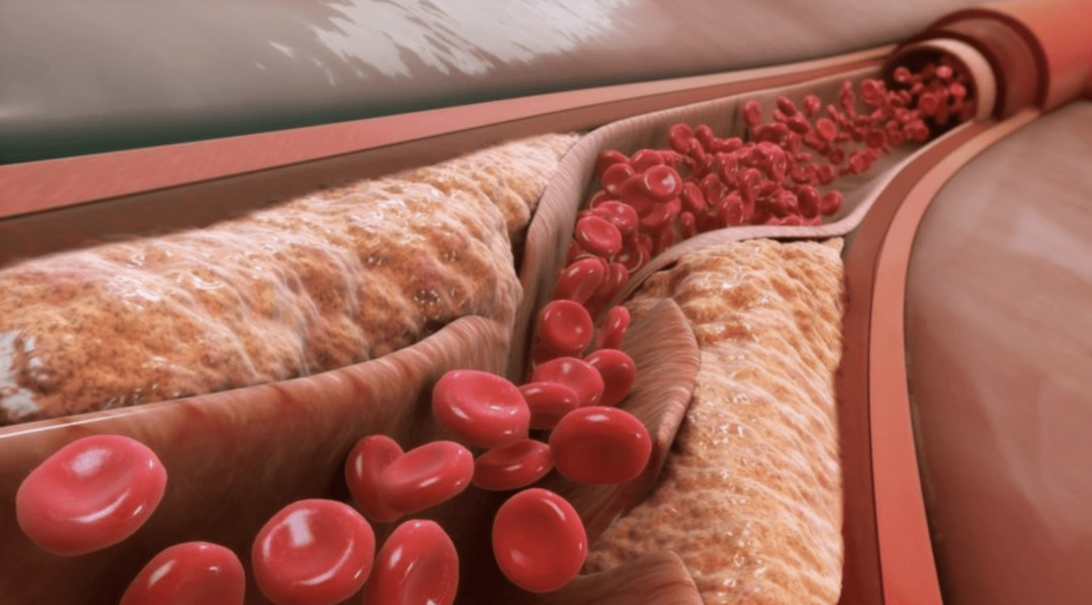 Ngoài tập thể dục, đây là một cách dễ dàng để giảm cholesterol xấu