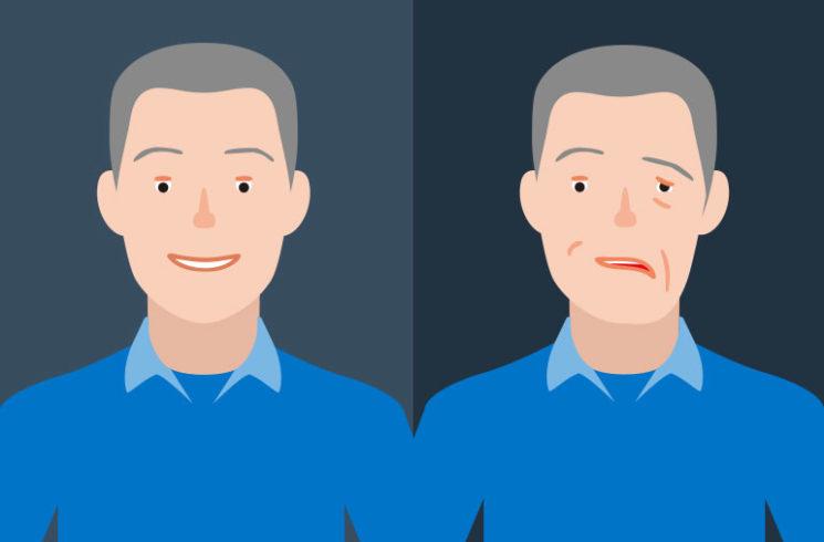 Liệt mặt Bell’s palsy và đột quỵ có giống nhau?