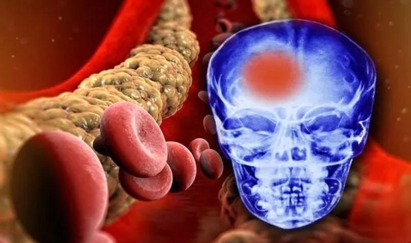 Mức chất béo trung tính cao có nguy cơ tử vong hoặc đột quỵ lên 21%