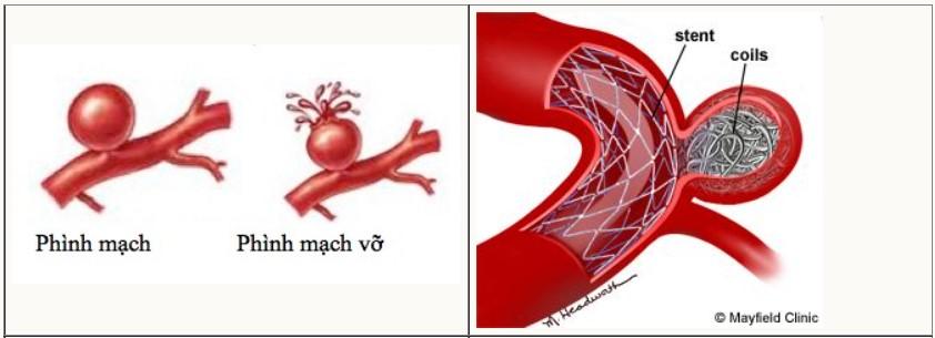 Hẹp động mạch cảnh điều trị bằng phương pháp nào?