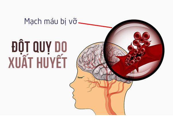 Tổng quan về đột quỵ xuất huyết não – căn bệnh nguy hiểm chết người