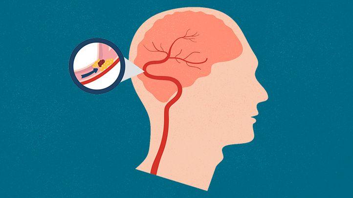 Hậu COVID-19, F0 lành bệnh có nguy cơ hình thành cục máu đông cao, làm tăng nguy cơ đột quỵ.