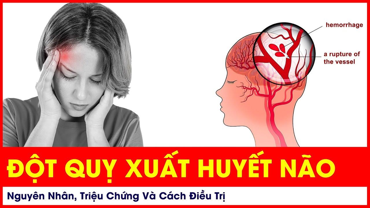 Đột quỵ xuất huyết não: Nguyên nhân, triệu chứng và cách điều trị